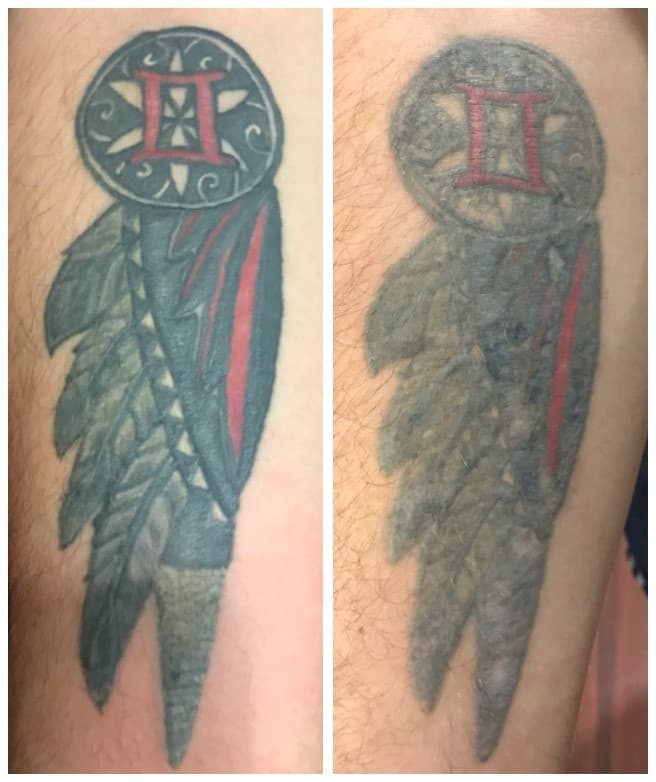 Lézeres tetoválás eltávolítás