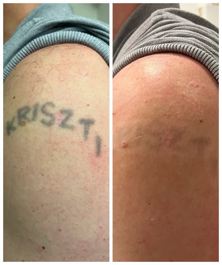 Lézeres tetoválás eltávolítás