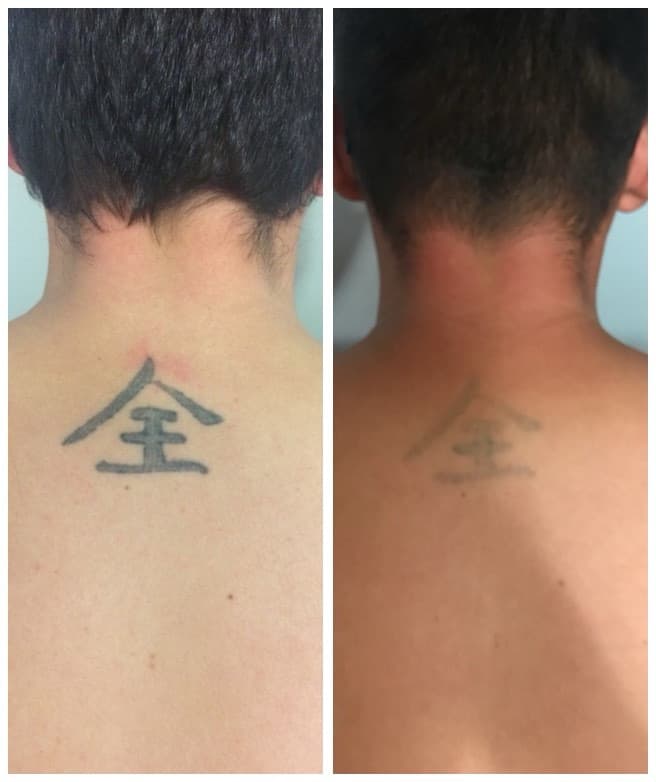 Lézeres tetoválás eltávolítás